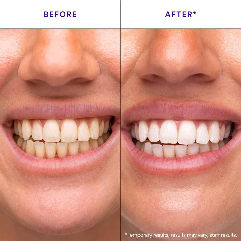 Hismile V34 Whitening Strips, Teeth Whitening Strips, Purple Tooth Whitening, Tooth Stain Treatment, Combining Whitening and Colour Correction